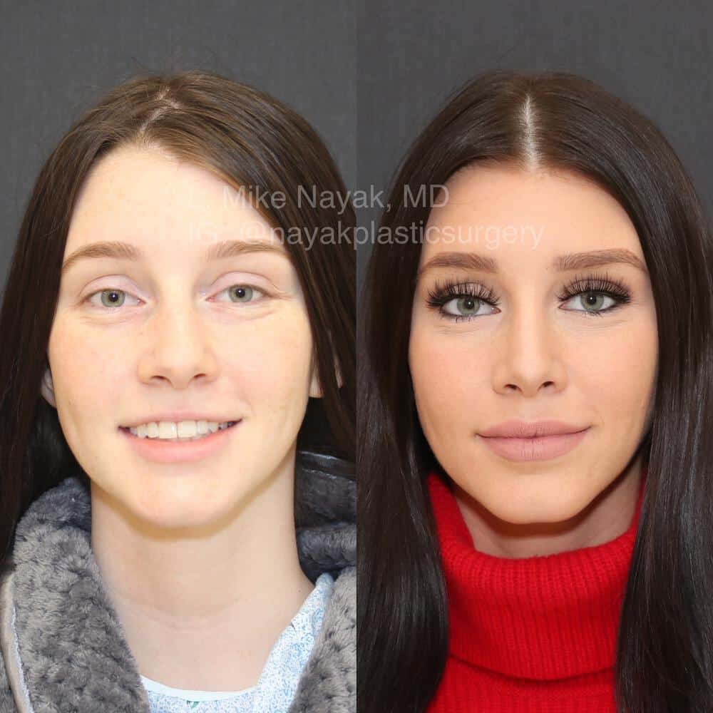 Rhinoplasty Costs St. Louis Missouri Rhinoplasty Costs St. Louis Missouri