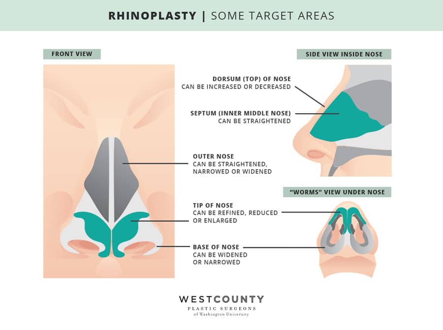 Rhinoplasty Costs St. Louis Missouri Rhinoplasty Costs St. Louis Missouri