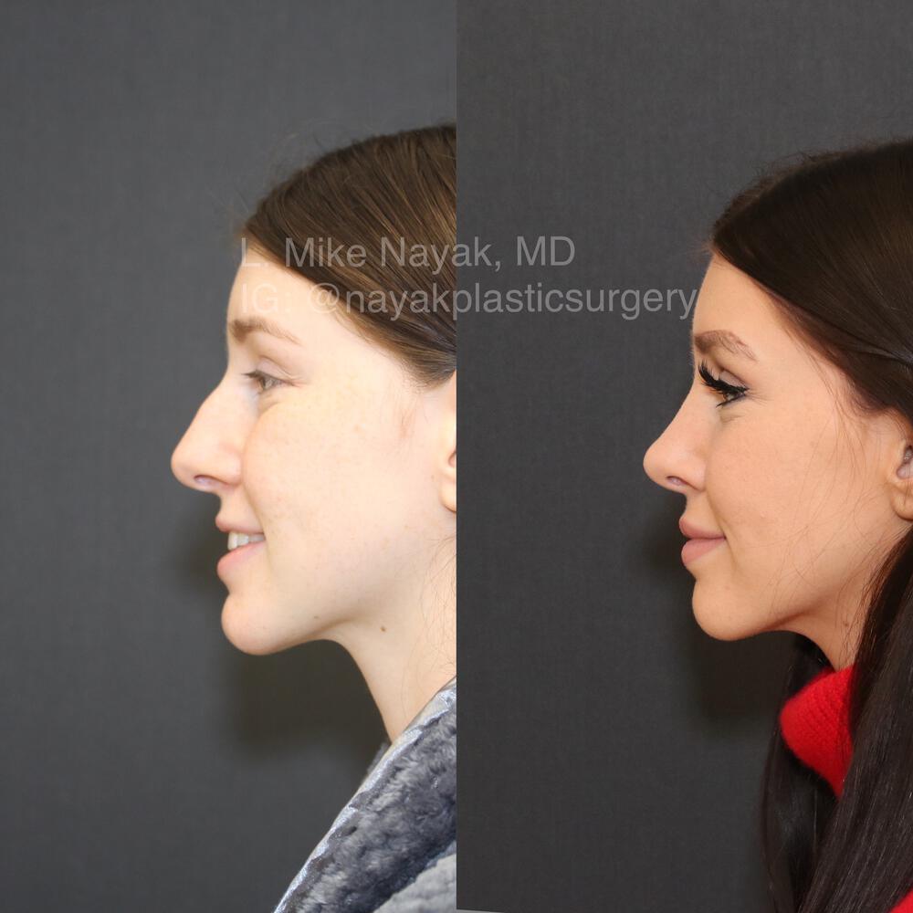 Rhinoplasty Costs St. Louis Missouri Rhinoplasty Costs St. Louis Missouri