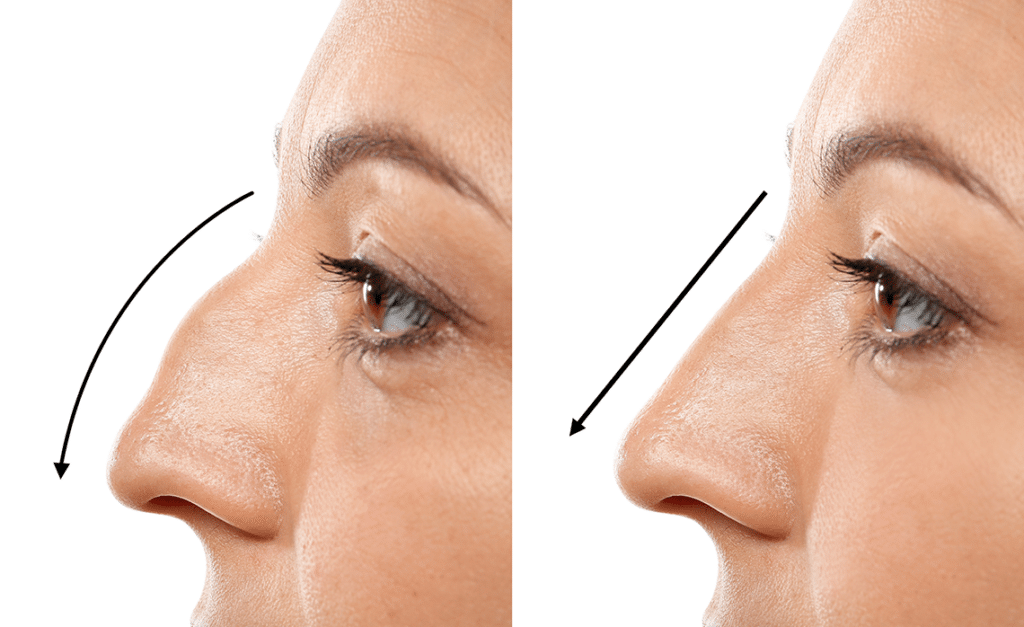 Rhinoplasty Costs Sterling Heights Michigan