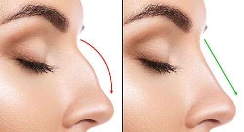 Rhinoplasty Costs Sterling Heights Michigan
