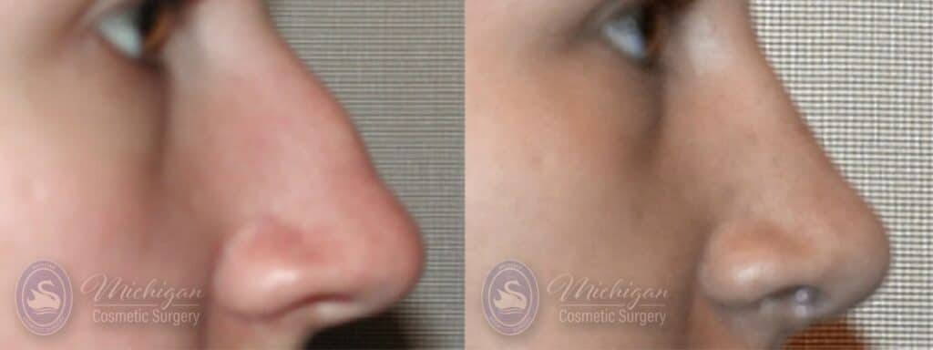 Rhinoplasty Costs Sterling Heights Michigan