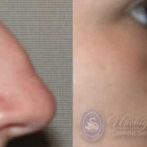 rhinoplasty costs sterling heights michigan 4