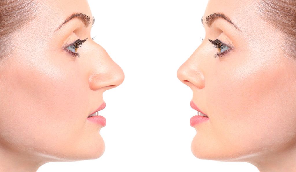 Rhinoplasty Costs Tallahassee Florida