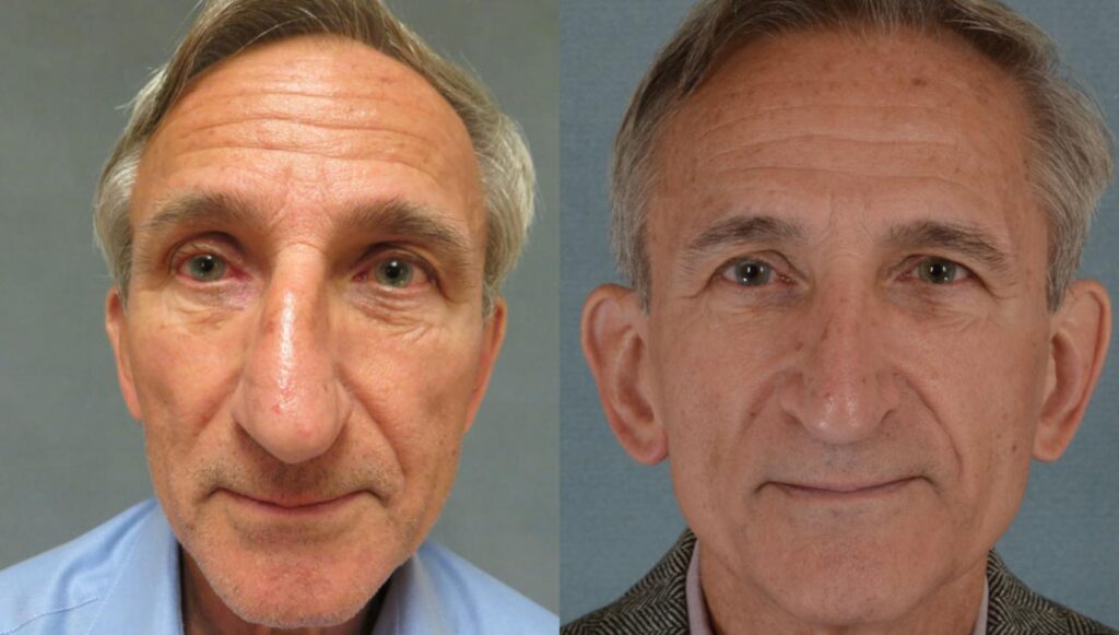 Rhinoplasty Costs Tallahassee Florida