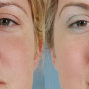 rhinoplasty costs tallahassee florida 4