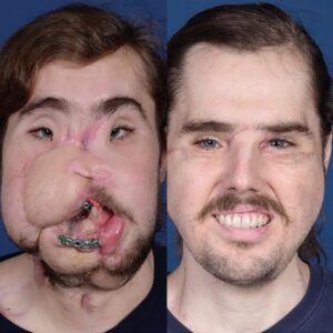 rhinoplasty costs waco texas