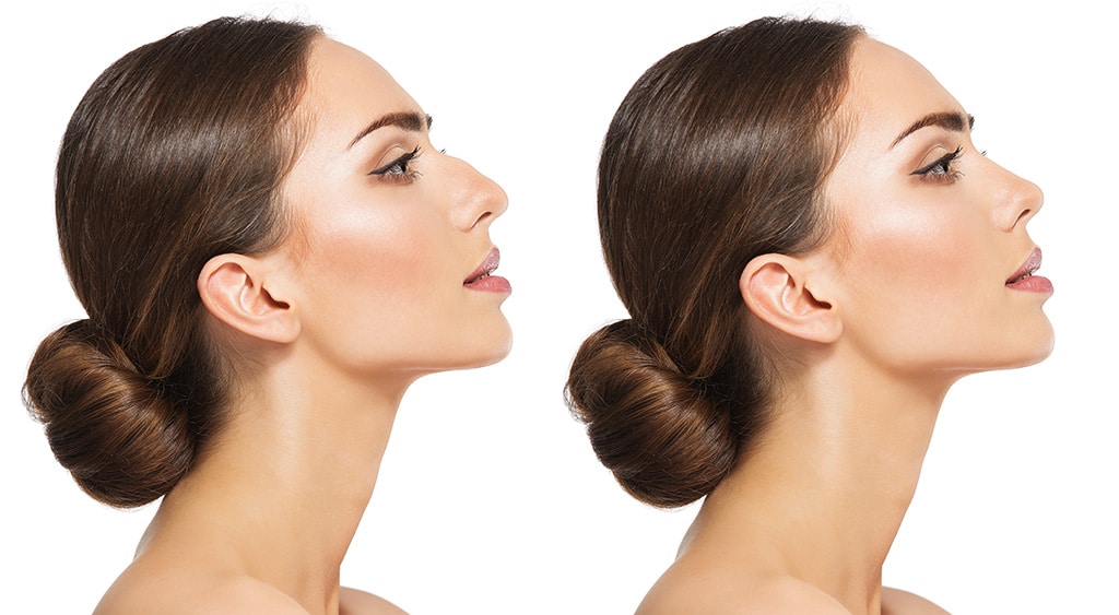Rhinoplasty Costs Warren Michigan