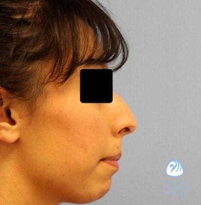 Rhinoplasty Costs Wichita Kansas