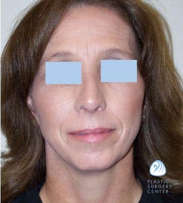 Rhinoplasty Costs Wichita Kansas