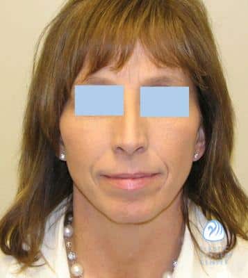 Rhinoplasty Costs Wichita Kansas
