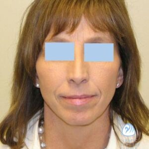 rhinoplasty costs wichita kansas 4