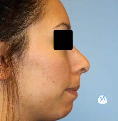 Rhinoplasty Costs Wichita Kansas