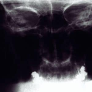 Photo Rhinoplasty Costs