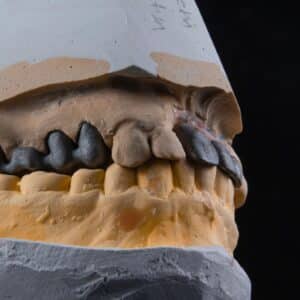 Photo Rhinoplasty Facelift Combination