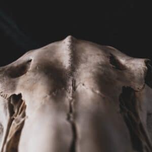 Photo Rhinoplasty Results