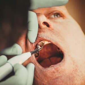 Photo Nose Reshaping Surgery