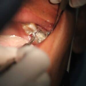 Photo Nose Reshaping Surgery