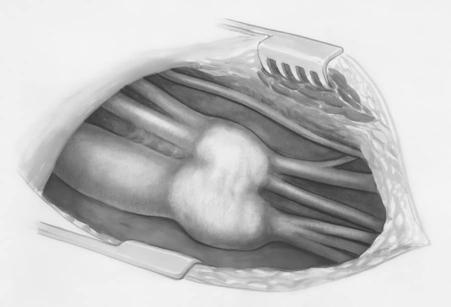 Open Rhinoplasty Spectrum at Val Vista Gilbert 1 Rhinoplasty