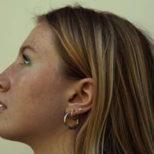 Photo Revision Rhinoplasty