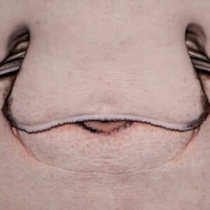 Photo Cosmetic Nose Surgeon