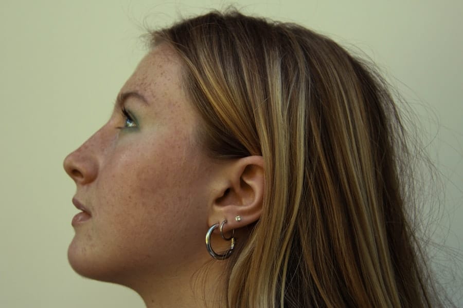 Photo Revision Rhinoplasty Seville Gilbert Az