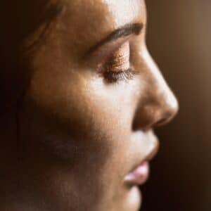 Photo Revision Rhinoplasty